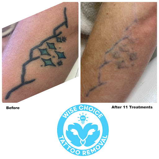 Explore good tattoo ideas for sisters, creative tattoo ideas in Denver, available at Wise Choice Tattoo Removal