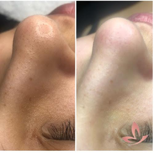 Dra. Michelle Fisio Dermatofuncional - Estética Facial -Limpeza de pele - Dermaplaning - Microagulhamento - Acne - Manchas - Maquiagem - Peelings - Sobrancelhas - Microblading - Rejuvenescimento - São Paulo