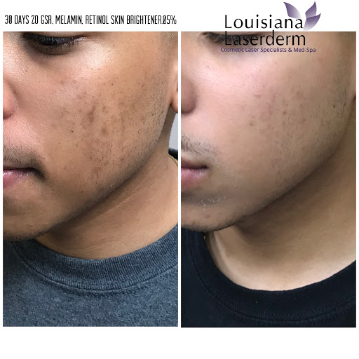 Explore mockingbird tattoo ideas, creative tattoo ideas in Baton Rouge, available at Louisiana Laserderm