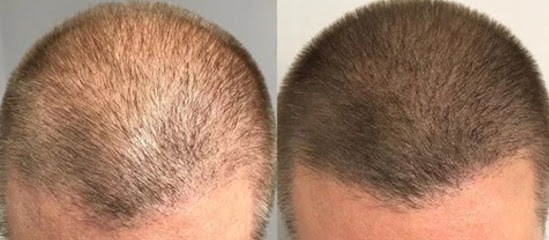 Scalp Micropigmentation By Fuller Hair