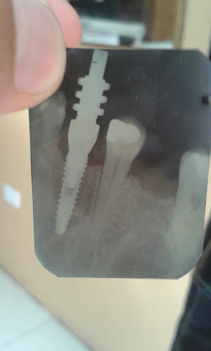 Opiniones de Implantes Dentales Ambato en Ambato - Médico