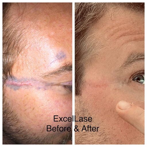 Explore donut tattoo ideas, creative tattoo ideas in Raleigh, available at ExcelLase