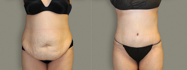 Athenix Body Sculpting Institute - Portland - Athenix Body Sculpting Institute - Portland