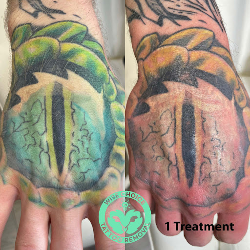 Explore astros tattoo ideas, creative tattoo ideas in Denver, available at Wise Choice Tattoo Removal