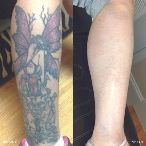 Explore ethiopian tattoo ideas, creative tattoo ideas in Honolulu, available at Removery Tattoo Removal & Fading