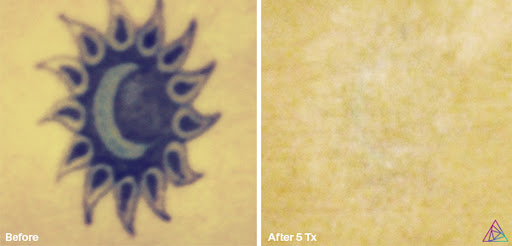 Explore jason voorhees tattoo ideas, creative tattoo ideas in Fort Myers, available at Laser Tattoo Removal by Tatt Cemetery