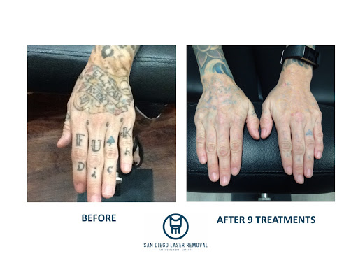 Explore vienna billy joel tattoo ideas, creative tattoo ideas in San Diego, available at Removery Tattoo Removal & Fading