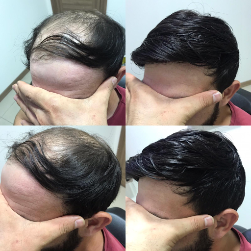 Hair Lost Protez Saç Merkezi