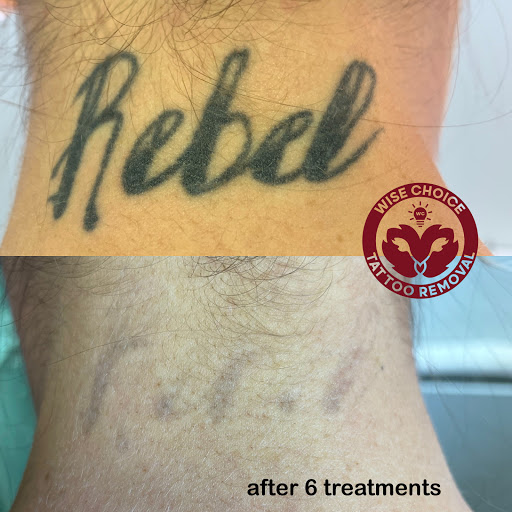 Explore nice first tattoo ideas, creative tattoo ideas in Denver, available at Wise Choice Tattoo Removal