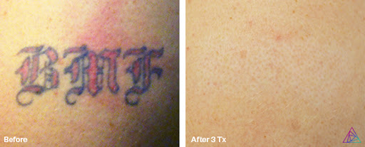 Explore ninja turtles tattoo ideas, creative tattoo ideas in Fort Myers, available at Laser Tattoo Removal by Tatt Cemetery