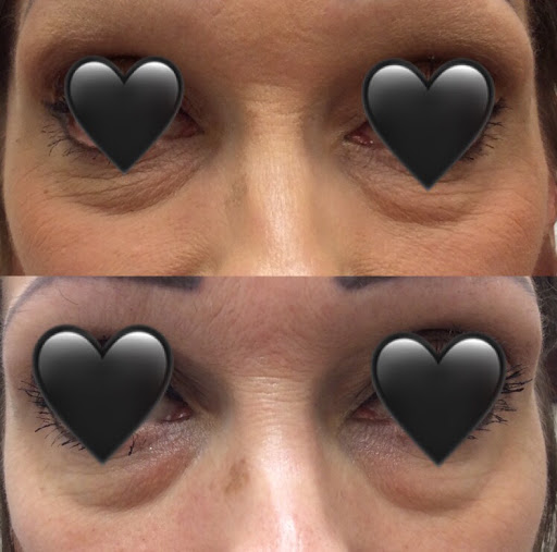 Find tattoo ideas bear for your next unique tattoo in Lake Oswego at Lake Oswego Vein and Aesthetic LOVA