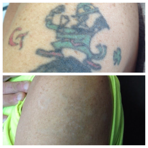 Explore skulls tattoo ideas, creative tattoo ideas in Northampton, available at Removery Tattoo Removal & Fading