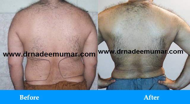 Dr. Nadeem Umars Cosmos Club - Hair Transplant & Liposuction Clinic