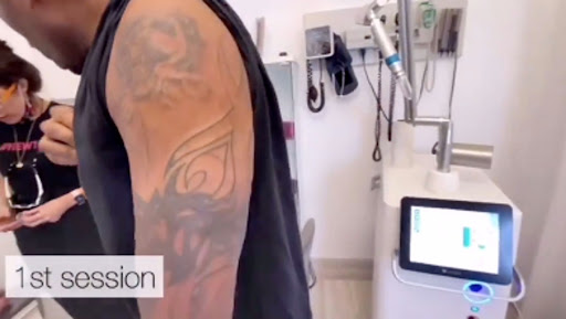 Explore side thigh tattoo ideas, creative tattoo ideas in Hallandale, available at Laser Treatments by Ageless Body Clinic