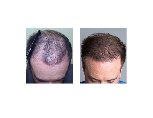 Hair Transplantation Clinic «Bosley Medical - Minneapolis», reviews and photos, 12455 Ridgedale Dr #204, Minnetonka, MN 55305, USA