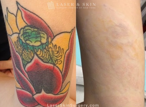 Explore outdoor tattoo ideas, creative tattoo ideas in Southampton, available at Laser & Skin Surgery Center of New York - Southampton