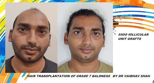 Dr Vaibhav Shah Hair Transplant clinic Mumbai