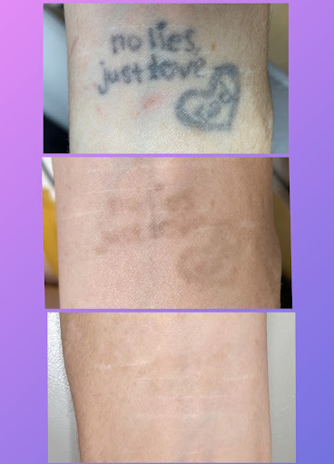 Explore easy tattoo cover up ideas, creative tattoo ideas in Pittsburgh, available at Goodbye Rhonda - Laser Tattoo Removal