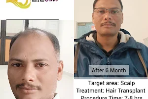 Emphoria Hair Clinic - Hair Transplant/Best PRP Treatment Clinic in Jammu image