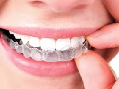 mBrace Frisco Orthodontics
