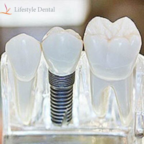 Lifestyle Dental And Implant Clinic - Dentist