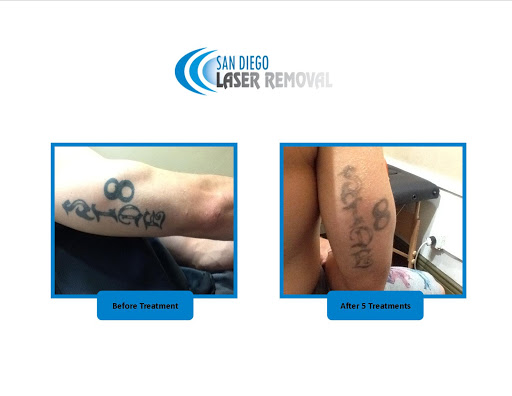 Explore small medusa tattoo ideas, creative tattoo ideas in San Diego, available at Removery Tattoo Removal & Fading