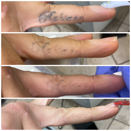 Explore zero tattoo ideas, creative tattoo ideas in Middle Village, available at Bye Bye Ink Laser Tattoo Removal