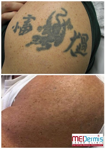 Find book of tattoo ideas for your next unique tattoo in San Antonio at MEDermis Tattoo Removal