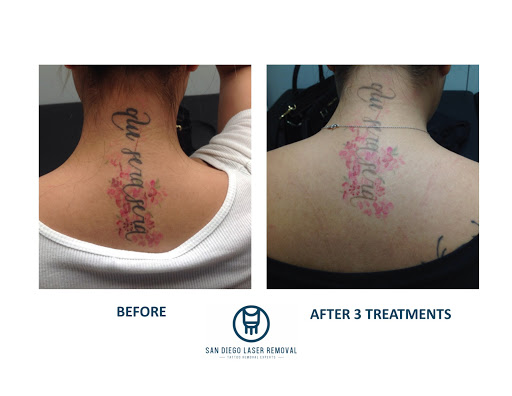 Explore color flower tattoo ideas, creative tattoo ideas in San Diego, available at Removery Tattoo Removal & Fading