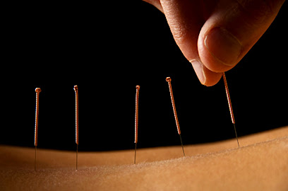 Acupuncture Alternatives, LLC