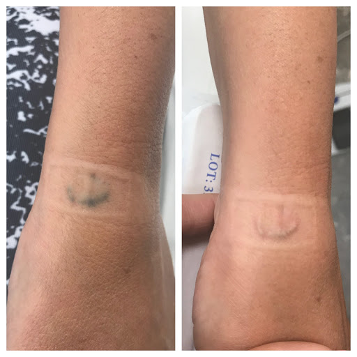 Explore 3 initial tattoo ideas, creative tattoo ideas in Middle Village, available at Bye Bye Ink Laser Tattoo Removal