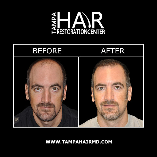 Hair Replacement Service «Tampa Hair Restoration Center», reviews and photos, 6730 W Linebaugh Ave #101a, Tampa, FL 33625, USA