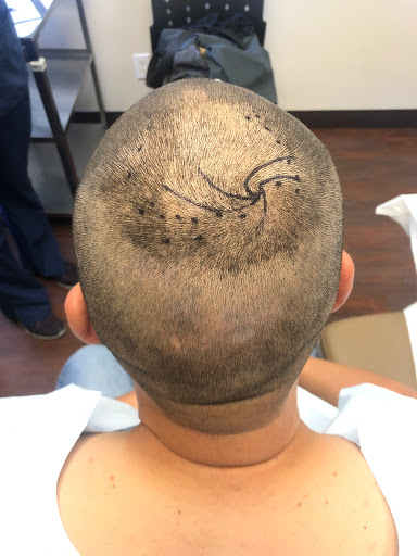 Hair transplantation clinic Escondido