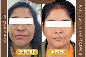 GLAMELITE24 SKIN CLINIC, Skin | Hair | Laser Clinic in Hinjewadi, Pimpri Chinchwad, Pune image