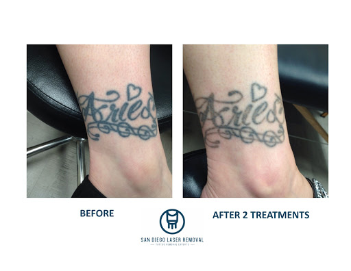 Explore walk in tattoo ideas, creative tattoo ideas in San Diego, available at Removery Tattoo Removal & Fading