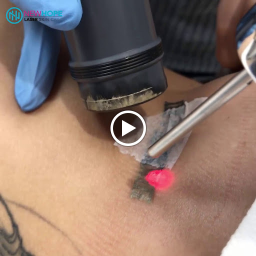 Explore lotus flower tattoo ideas, creative tattoo ideas in Westminster, available at Newhope Laser Skin Care