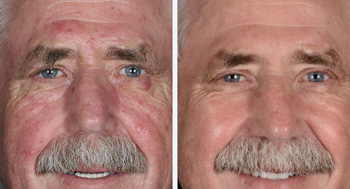 Explore stitch tattoo ideas for ladies, creative tattoo ideas in Englewood, available at Laser Remedy Skin Solutions