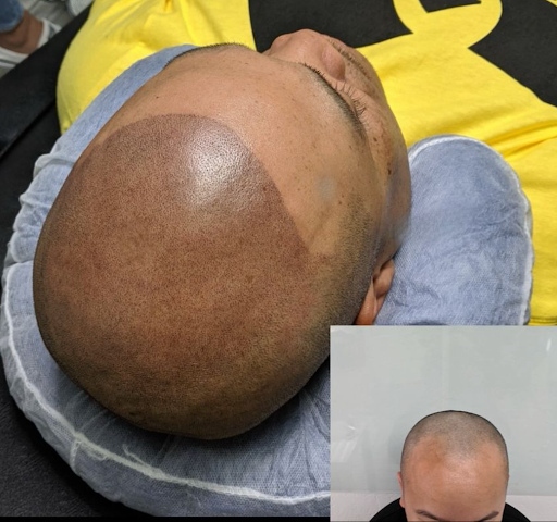 Explore 2004 tattoo ideas, creative tattoo ideas in Roseville, available at NuHair Ink. Scalp MicroPigmentation & Aesthetic Clinic of Sacramento