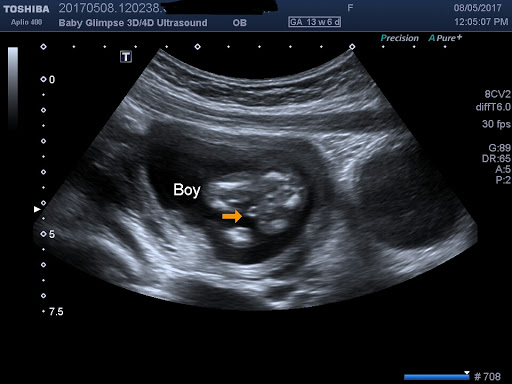 Baby Glimpse 3D/4D ultrasound