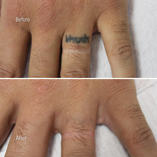 Explore gen x tattoo ideas, creative tattoo ideas in Chandler, available at Removery Tattoo Removal & Fading