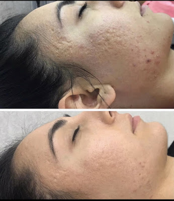 LED THÉRAPIE ET MICRONEEDLING à Vincennes