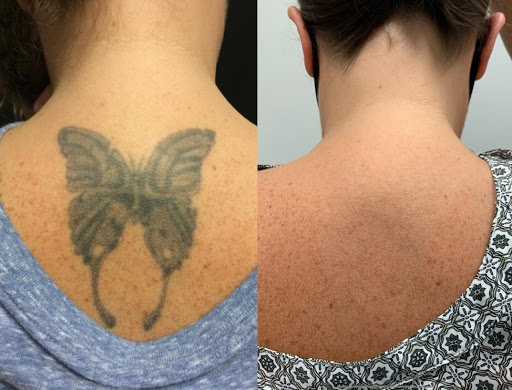 Explore cover up shoulder tattoo ideas, creative tattoo ideas in Houston, available at Removery Tattoo Removal & Fading