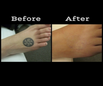 Explore cover up tattoo ideas for ladies, creative tattoo ideas in Longview, available at Vanish Laser Aesthetics
