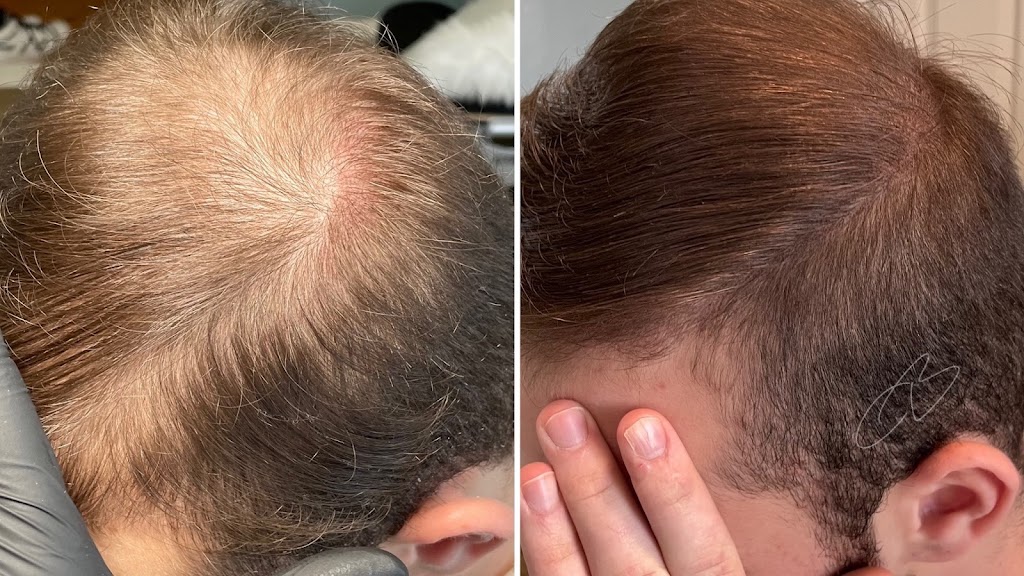 Hair loss treatment center Chana's Beauty LLC. Hair extensions 11598