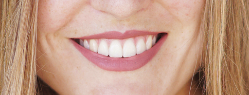 Fastteeth - Zahnkorrektur für Erwachsene