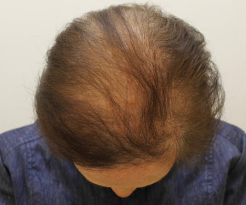 عيادات تساقط الشعر - كارلايل - The Hair Loss Clinics - Carlisle