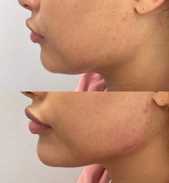Lip augmentation specialists in Fairfax thumbnail