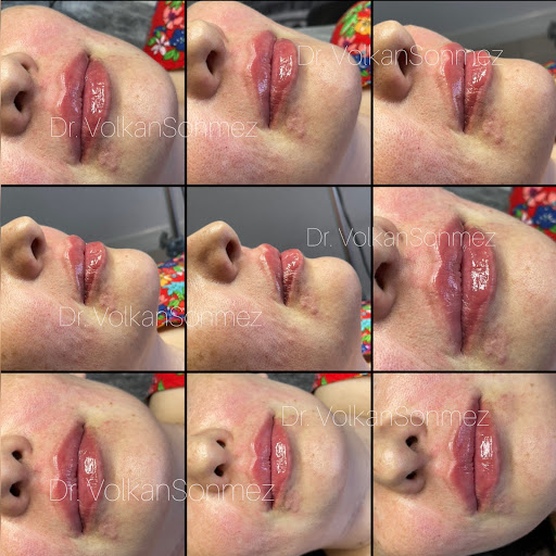 Dr. Volkan Sonmez Aesthetic ~ Dermatology Doctor - Botox - Filler - Lip Filler - Dolgu - Dudak Dolgusu
