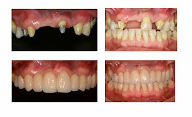 Implante Dentário - Clínica Dental Design - Dentista