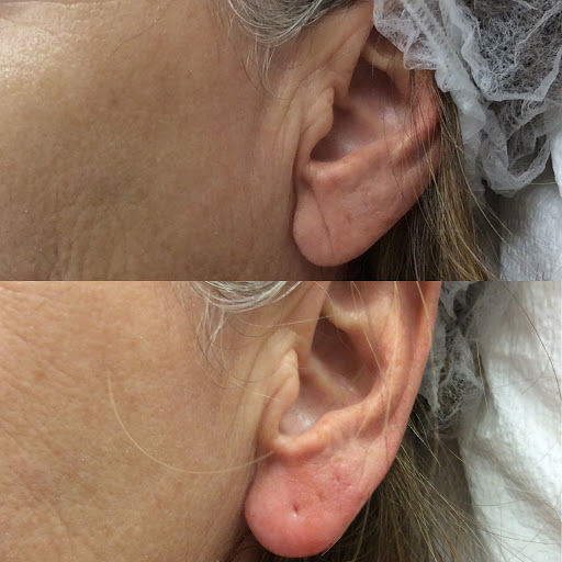 Explore tattoo rings ideas, creative tattoo ideas in Lake Oswego, available at Lake Oswego Vein and Aesthetic LOVA